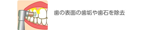 歯の表面の歯垢や歯石を除去