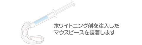 ホワイトニング剤を注入したマウスピースを装着します