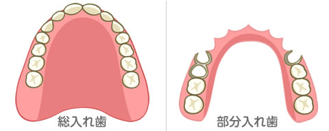 虫歯の進行、C3とC4のイラスト解説