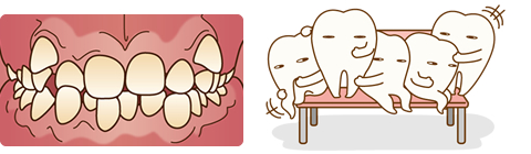 「歯が重なって生えている」「八重歯」「受け口」「出っ歯」などのイメージイラスト